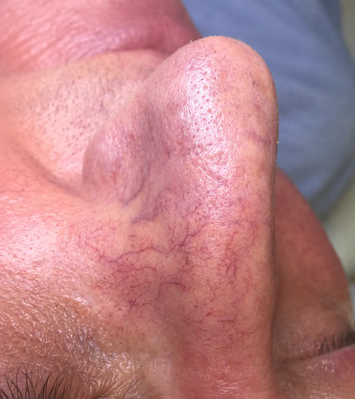 Couperose treatment