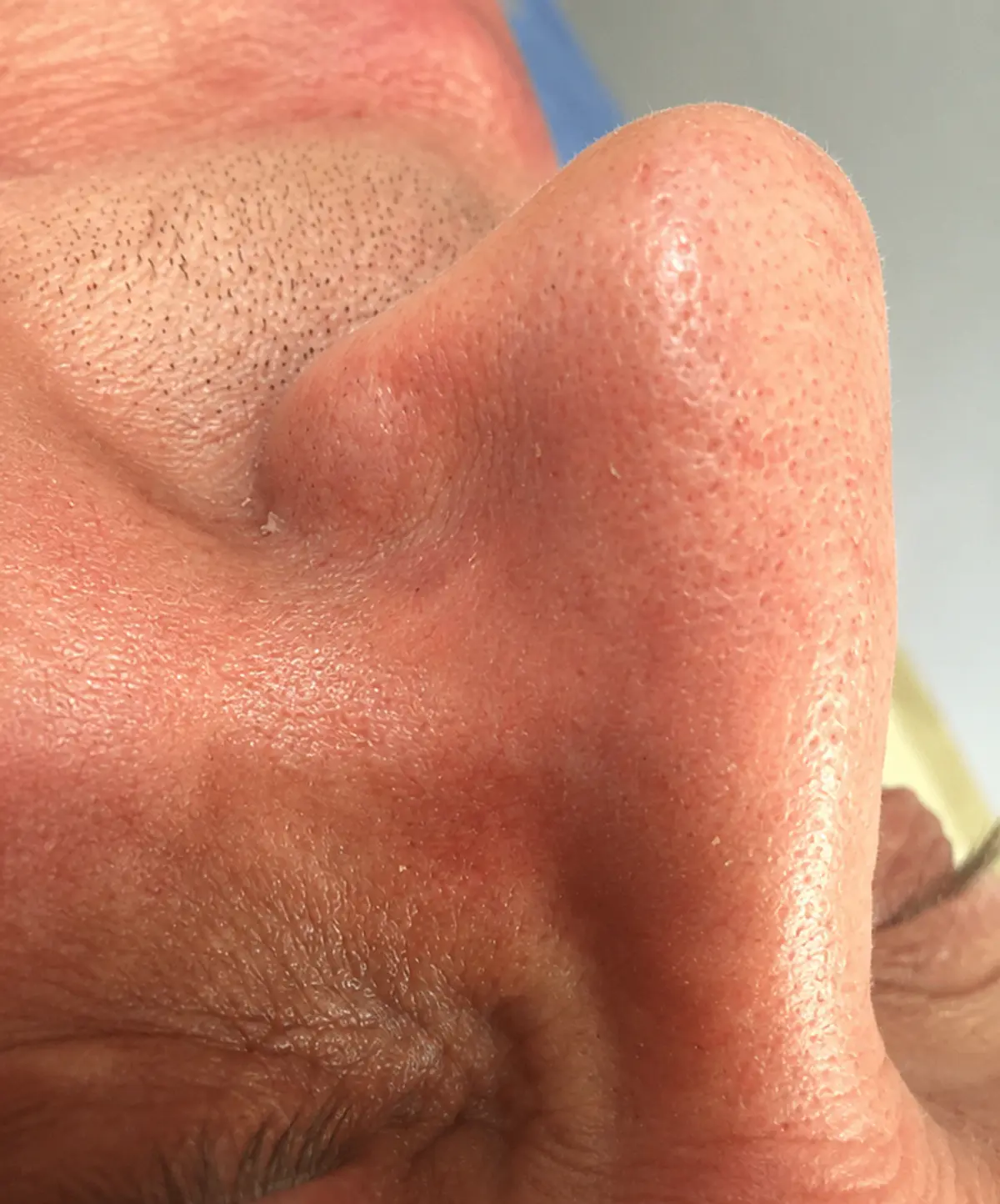 Couperose treatment