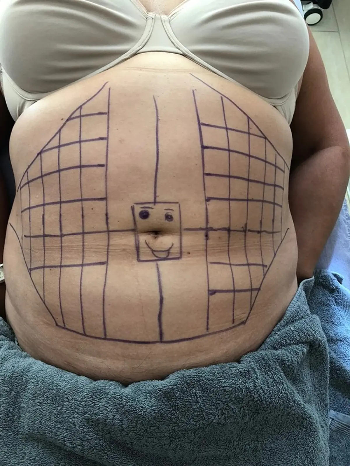 Case Study 5: Before<br>Lipo Cavitation & Radiofrequency
