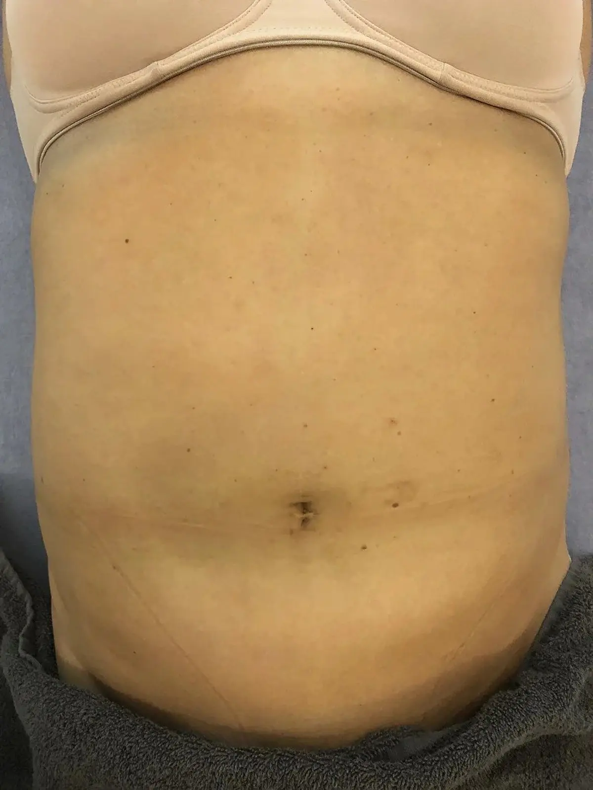 Case Study 5: After<br>Lipo Cavitation & Radiofrequency