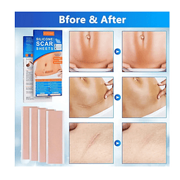 2 Parches De Silicona Para Cicatrices-queloides (ref 21220)