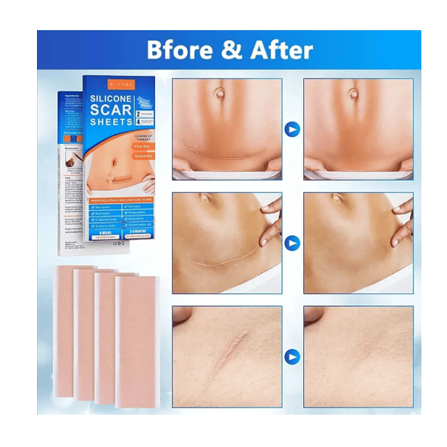 2 Parches De Silicona Para Cicatrices-queloides (ref 21220)