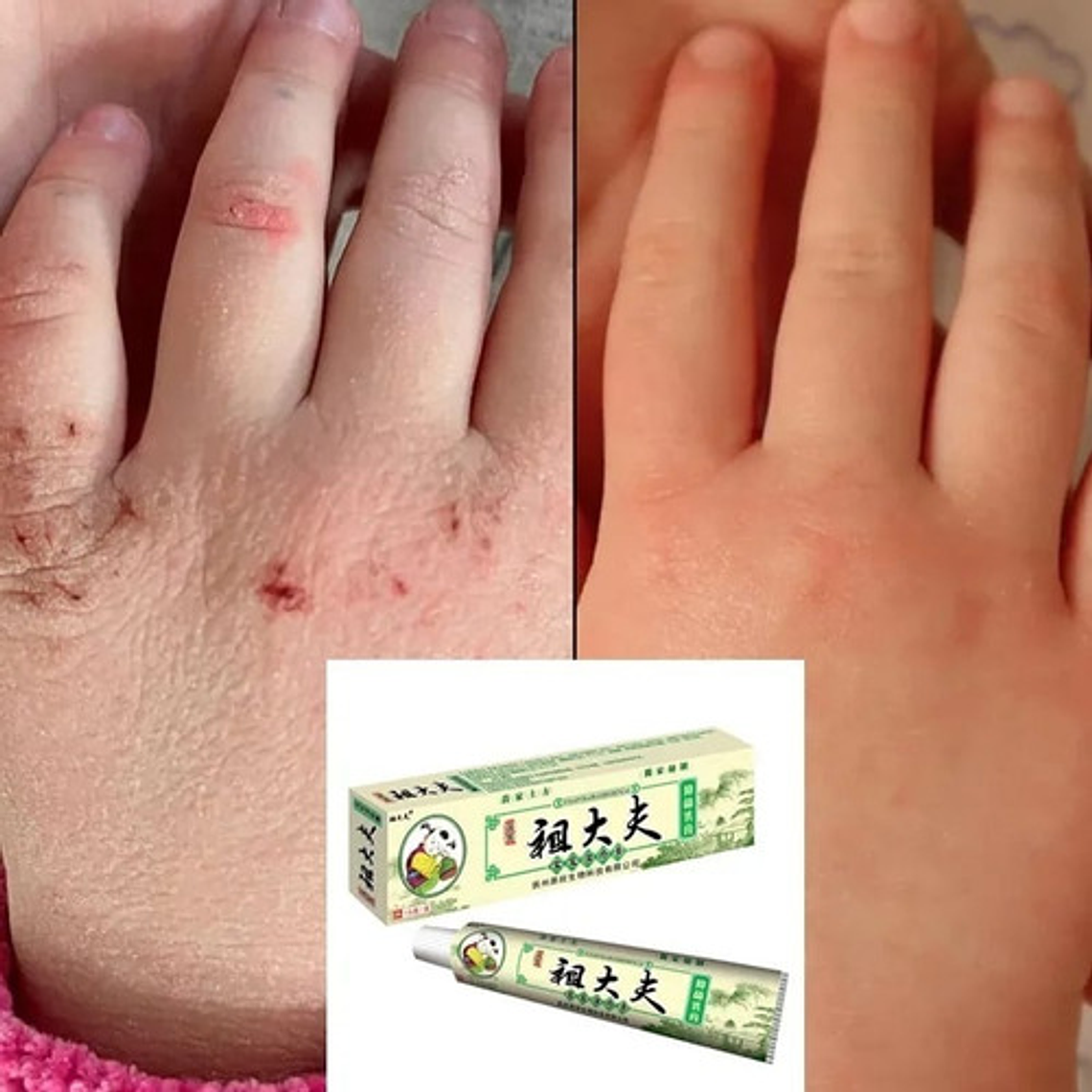 Crema Cuidado Piel Psoriasis Eczema Prurito Acné Zudaifu 3