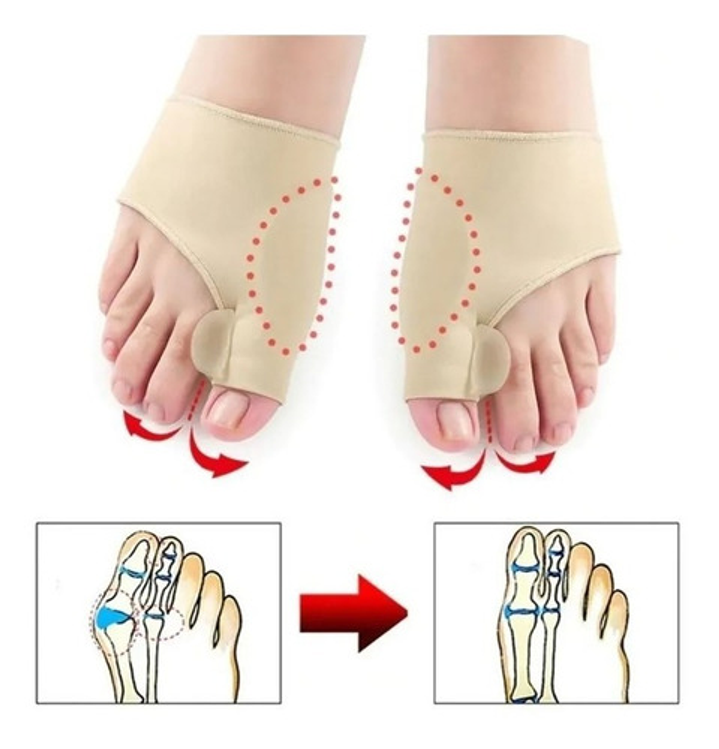 Corrector De Juanetes Con Gel Médico [1 Par Ambos Pies] 2