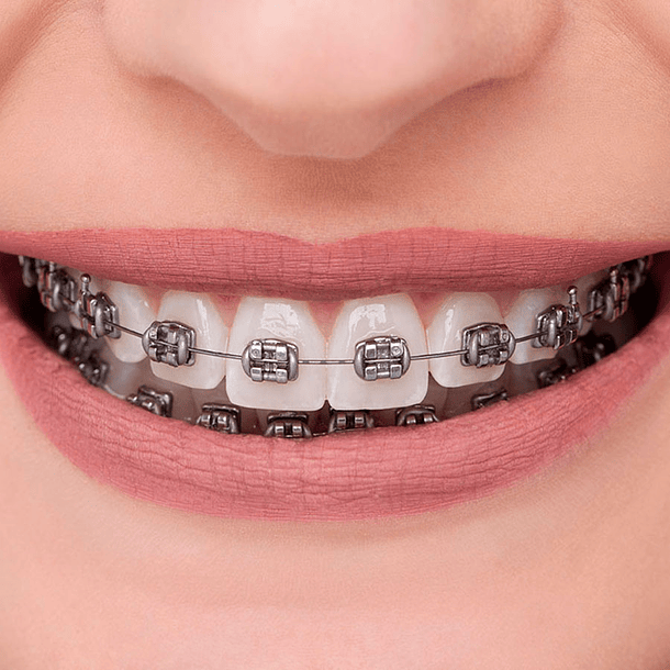 CASO BRACKETS METÁLICOS ADVANCED SERIES ORTHOMETRIC 2