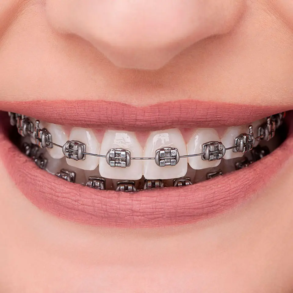 CASO BRACKETS METÁLICOS ADVANCED SERIES ORTHOMETRIC 2