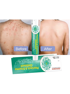 Crema Jemeesen a Base de Extractos Naturales para el Cuidado de la Piel con Tendencia a Psoriasis y Eczema – 20 g