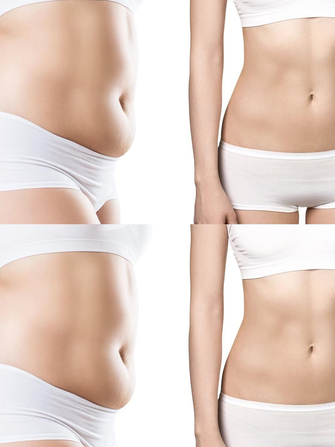 Reafirmación Abdominal Postparto con Exilis 360 (8 Sesiones) 1