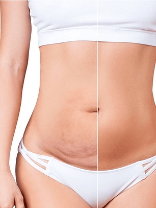 Remodelación Abdominal: Morpheus8 (3 Sesiones) + DMAE (3 Sesiones)