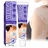 Tratamiento de vitíligo, crema natural para vitíligo, eficaz