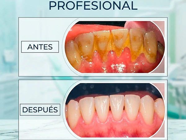 Limpieza Dental en Santiago: Prevención y Salud para tu Sonrisa