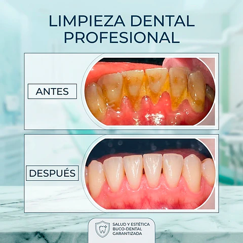 Limpieza Dental Profesional (Agendamiento Directo)