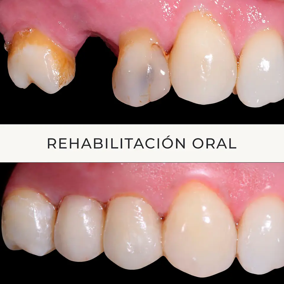 Rehabilitación Oral en Providencia 1