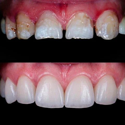 Diseño de Sonrisa con Carillas Dentales