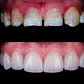 Diseño de Sonrisa con Carillas Dentales - Miniatura 1