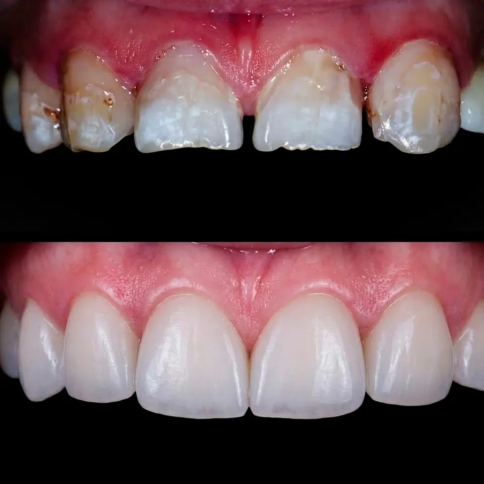 Diseño de Sonrisa con Carillas Dentales 1