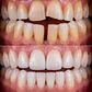 Diseño de Sonrisa con Carillas Dentales - Miniatura 2