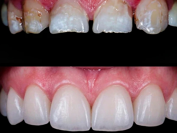 Diseño de Sonrisa con Carillas Dentales en Santiago | Estética XBUCAL