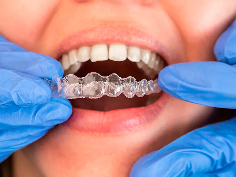 Plano de Relajación en Santiago: La Solución Clínica al Bruxismo, Dolores de Cabeza y Desgaste Dental