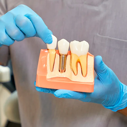 Implantología Dental: Recupera la Función y Estética de tu Sonrisa