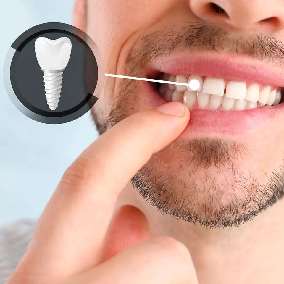 Implantología Dental: Recupera la Función y Estética de tu Sonrisa 3