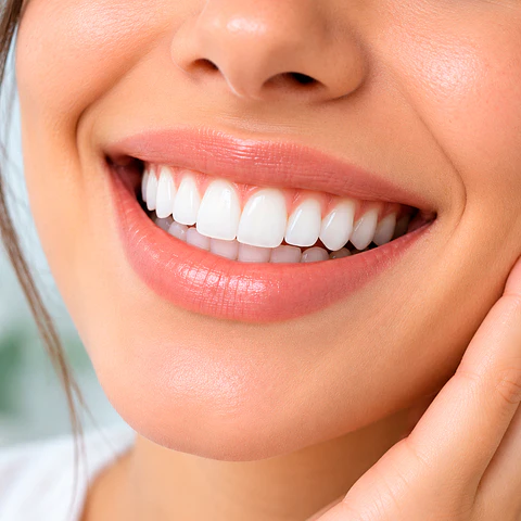 Blanqueamiento Dental
