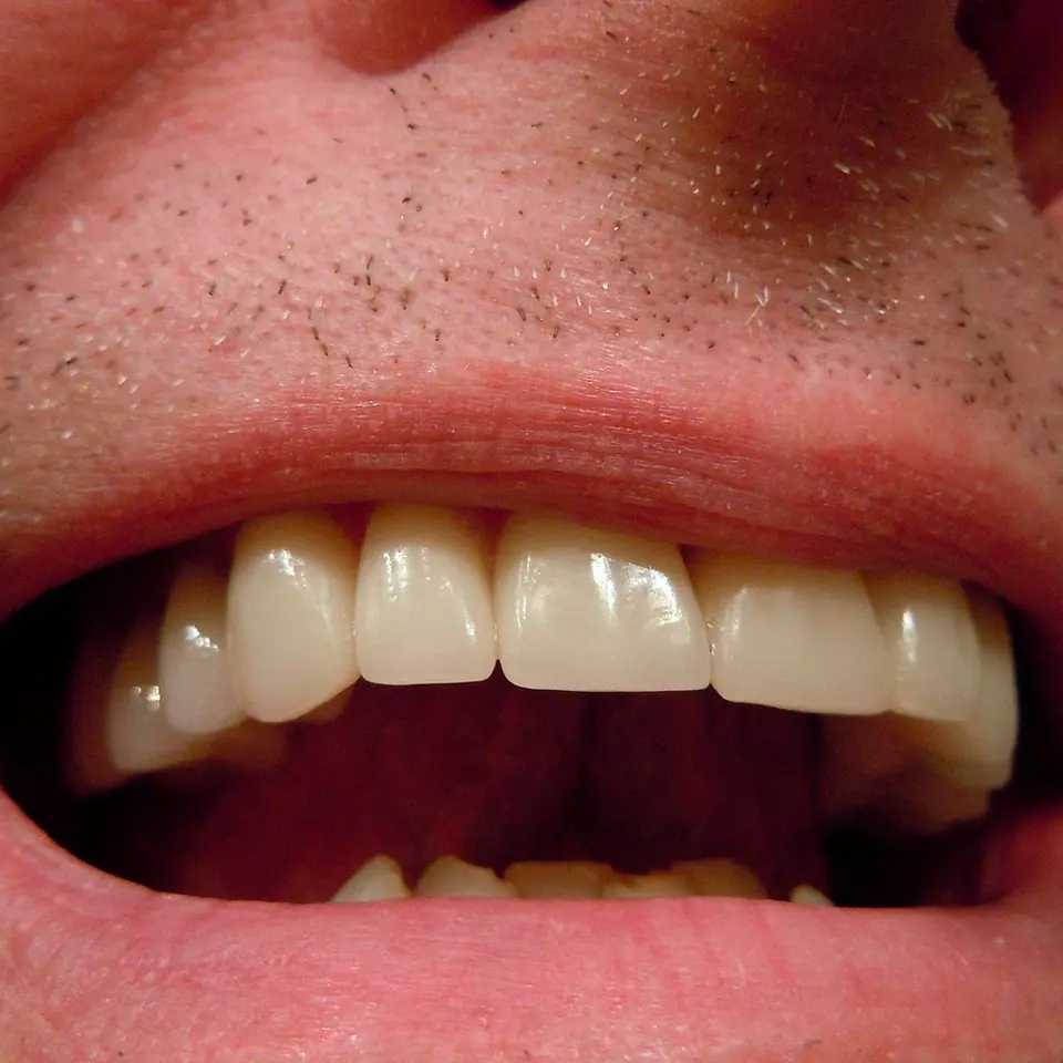 Blanqueamiento Dental 2