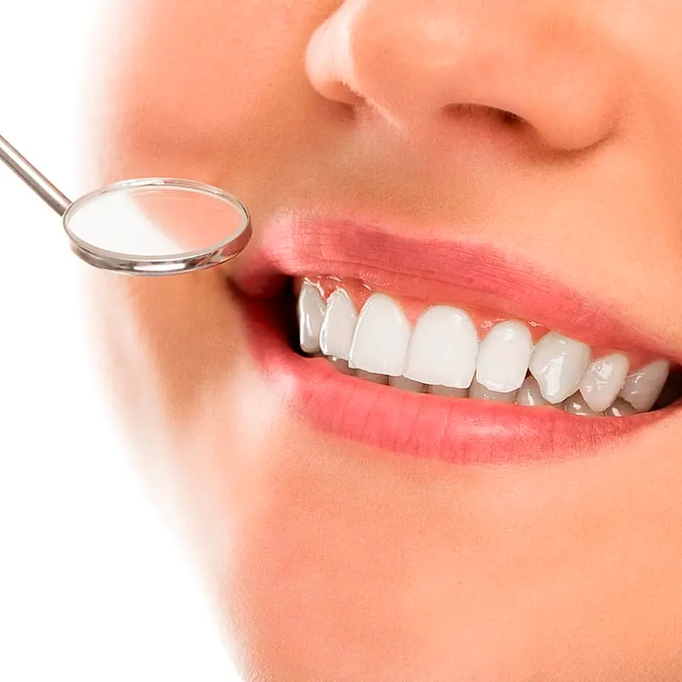 Blanqueamiento Dental 3