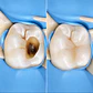 Tratamiento de Caries y Restauraciones Estéticas (Tapaduras de Resina) - Miniatura 1