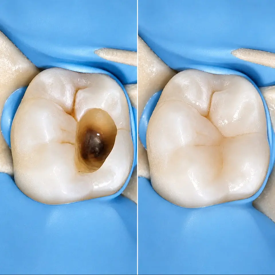 Tratamiento de Caries y Restauraciones Estéticas (Tapaduras de Resina) 1