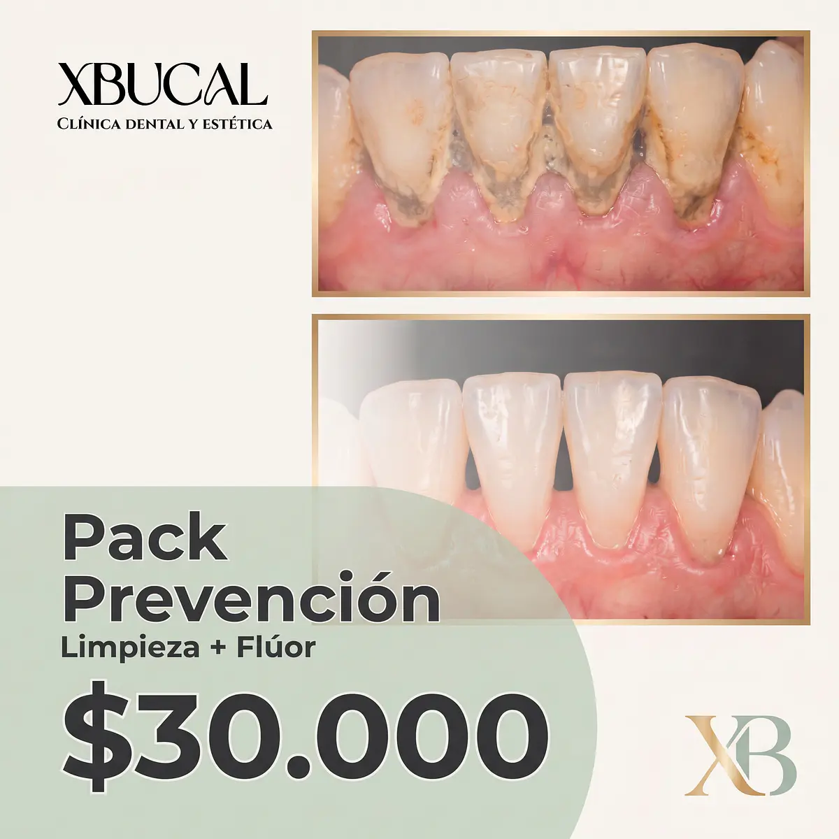 Xbucal